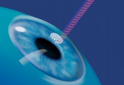Лазерная хирургия глаза